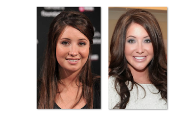 Bristol Palin Plastic Surgery – Before And After