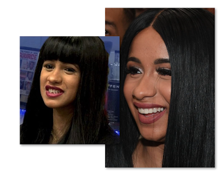 Cardi B Teeth Before And After Old Smile Vs New