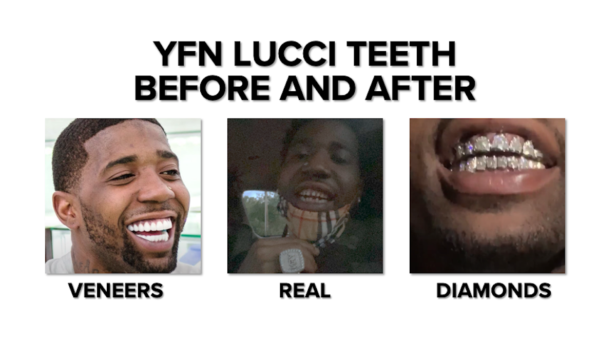 YFN Lucci Fake Teeth – Before And After
